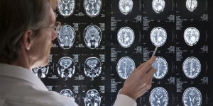 Cara Mengobati Kanker Otak